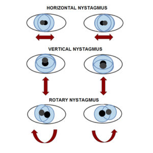 Nystagmus