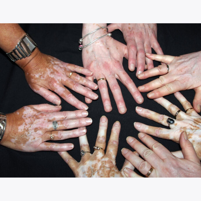 vitiligo op de handen