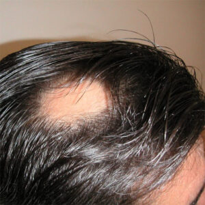 Alopecia vereniging